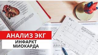 Инфаркт Миокарда. ЭКГ диагностика. Часть 1.