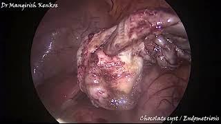 Endometriosis or Chocolate cyst ( Goa )