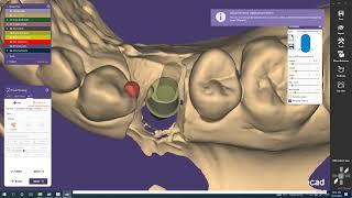 Custom Abutment Design with Exocad;