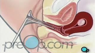 Vaginal Fibroid Removal Myomectomy Surgery • PreOp Patient Education