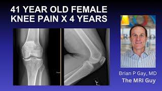 AVASCULAR NECROSIS (AVN) OF THE KNEE