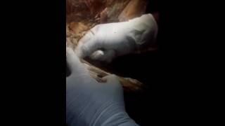 Dissection of arm(12)