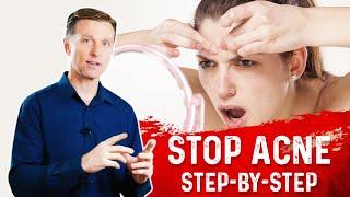 How To Get Rid Of Acne? Eliminate Acne Permanently! – Dr.Berg