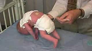 neurology exam: newborn-abnormal: Primitive Reflexes - Galant