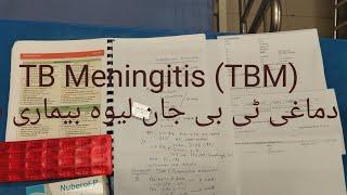 Tuberculous Meningitis (TBM) C/F & managment  دماغی ٹی بی جان لیوہ بیماری ہے