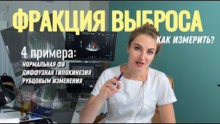 Как измерить ФРАКЦИЮ ВЫБРОСА? Полный урок! Измеряем ФВ в НОРМЕ, при диффузной гипокинезии, и РУБЦАХ