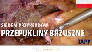 TAPP w przepuklinach brzusznych (pierwotnych i pooperacyjnych) - SIEDEM PRZYKŁADÓW