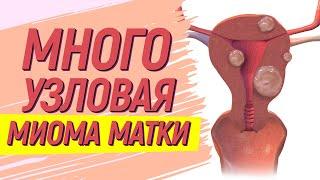 Многоузловая миома матки  Удалить нельзя лечить