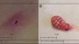 'Deeply embedded maggot' found living in woman's groin