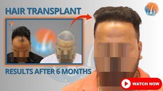 Amazing Hair Transplant Results After 6 Months | Alloroots | Dr Alok Sahoo