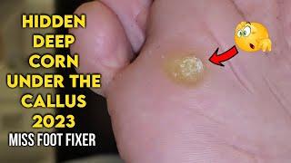 DEEP CORN/VERRUCA UNDER THE CALLUS ON BOTTOM OF FOOT TREATMENT BY FAMOUS PODIATRIST MISS FOOT FIXER