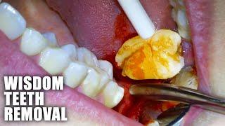 Full Wisdom Teeth Removal Procedure! Emergency Extraction of Impacted & Partially Erupted Molar