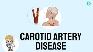 Carotid Artery Disease & carotid stent