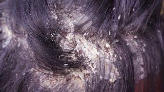 Dandruff Scratching Removal With Soft ASMR Hair Scalp Check #155