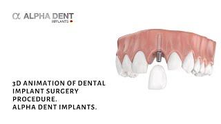 3D animation of dental implant surgery procedure. Alpha Dent Implants