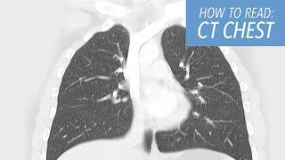 How to Read a CT of the Chest: Basic Search Pattern