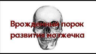 Диагностика аномалии Арнольда Киари врожденный порок развития мозжечка