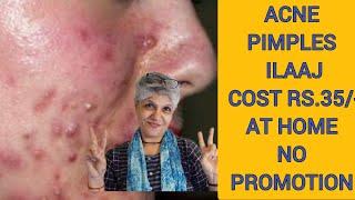 ACNE PIMPLES TREATMENT ₹35/- only | home treatment | good results|