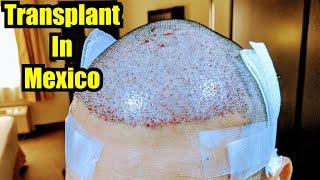 2nd Mexican Hair Transplant FUE-Hair Medical Restoration Tijuana