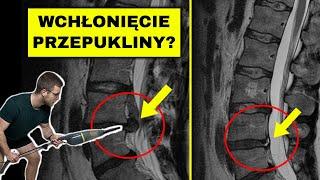 Przepuklina - czy może się cofnąć? (rwa kulszowa, dyskopatia) *kręgosłup lędźwiowy*