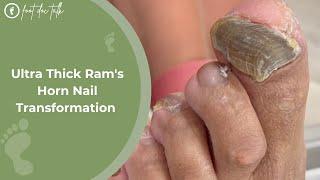 Ultra Thick Ram's Horn Nail Transformation