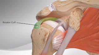 Superior Capsular Reconstruction