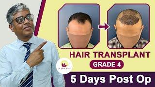 Grade 4 Hair Transplant Total 4164 Grafts using FUE | 5 Day After Post Operation | Dr. Ritesh Anand