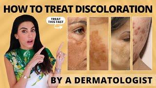 Dermatologist Reviews 4 Types of Hyperpigmentation | Treatments & Tips