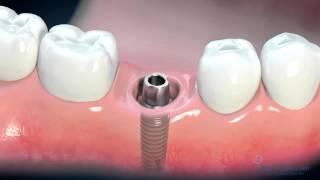 Dental Implant Consent Video