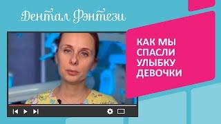 Травма двух передних зубов у ребёнка Как мы спасли улыбку девочки, в конце видео