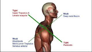 Cervical Protraction & Retraction + Cervicogenic Headaches Intro