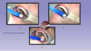 RPE (Expander) Instruction - Smile Solutions Orthodontists