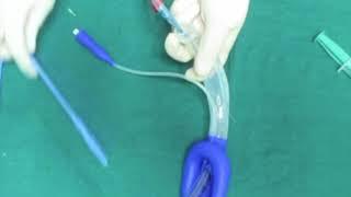 New technique to prevent pilot tube stretching while Air-Q guided intubation.