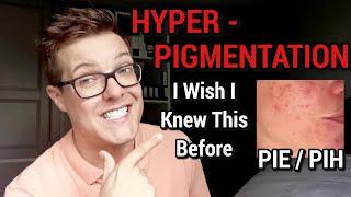 HYPERPIGMENTATION - 100% Effective Treatments (What Brands Wont Tell You)