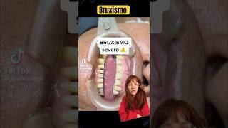 Bruxismo #shorts #bruxismo #bruxism #atm #odontologia #odonto #odontoblog #odontoblogmx