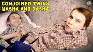 How Conjoined Twins Ended Up Taking Very Different Life Paths