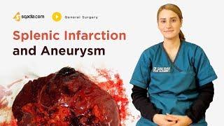 Splenic Infarction and Aneurysm | General Surgery Lectures | Student Education | V-Learning