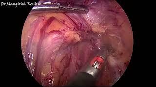 Frozen Pelvis - Laparoscopic Hysterectomy