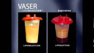 Vaser liposuction