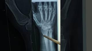 Keinbock disease. #malpractice #malpracticeinorthopedics #orthopedics #wristpain