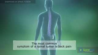 Spinal Tumor Symptoms