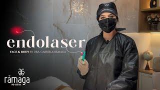 Endolaser: Conheça essa técnica revolucionária!