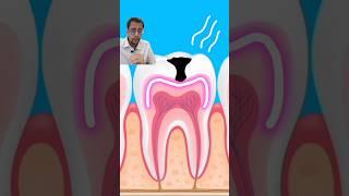 How does tooth decay happen! #dentist #teeth