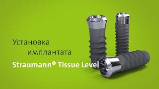 Установка имплантата: Straumann® Tissue Level