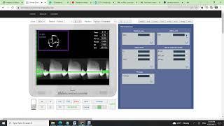 Mitral stenosis PHT