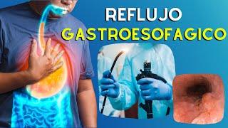  ERGE Causas, Diagnostico y Tratamiento de la Enfermedad por Reflujo Gastroesofágico | Podcast