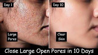 She Closed Large OPEN PORES in 10 Days - Remove Dark Spots | Rice Ice cubes & Aloevera Night Cream