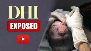 What is the DHI hair transplant? [SIMPLY EXPLAINED]