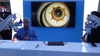 BrightMEM Anterior Keratoplasty ASCRS 2024