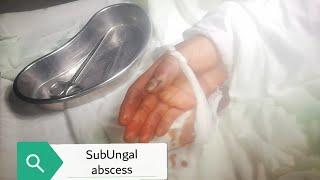 Subungal abscess with nail bed necrosis | nail removal | surgery | medico mnemonico